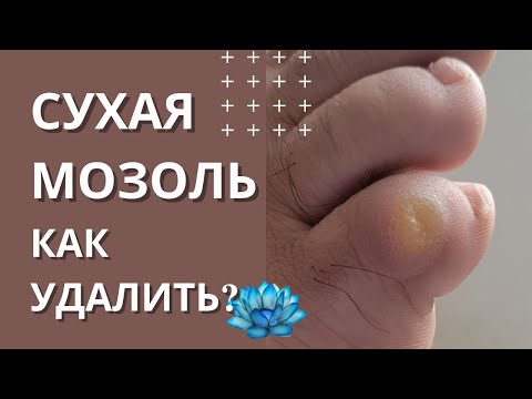 Сухая мозоль на ногах. Удаление сухих мозолей.