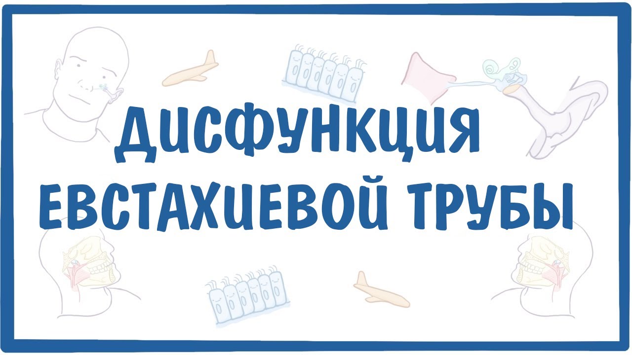 Дисфункция евстахиевой (слуховой) трубы (ДСТ) — причины, симптомы, патогенез, диагностика, лечение