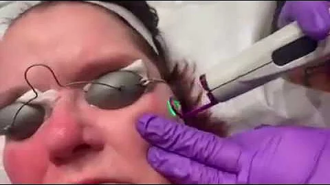 Do you have Rosacea or broken blood vessels?