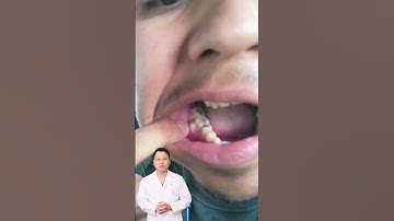 Viêm lợi răng hàm | Bác sĩ Cường #bacsicuong #shorts