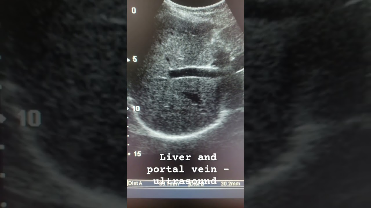 liver Ultrasound #education #ultrasound #study #sonography #liver #anatomy #education #medical #abd adlı videoyu YouTube'da izle liver Ultrasound #education #ultrasound #study #sonography #liver #anatomy #education #medical #abd adlı videoyu YouTube'da izle