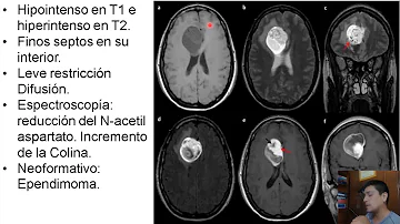 ¿Se pueden ver tumores en la RM sin contraste?