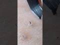 ［ドパガキ用］毛抜き動画 #hairremoval #satisfying #毛抜き #埋没毛 #髭抜き #tweezers