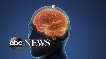 Brain chips aim to revolutionize tech by merging humans, computers