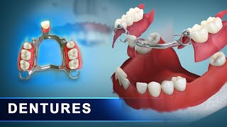 Dentures | Removal dentures - complete and partial - upper and lower jaw | 3d Dental Animation