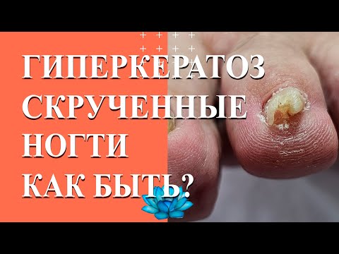 У клиента гиперкератоз ногтей. Аппаратный педикюр на скрученные ногти.