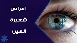 أعراض شعيرة العين