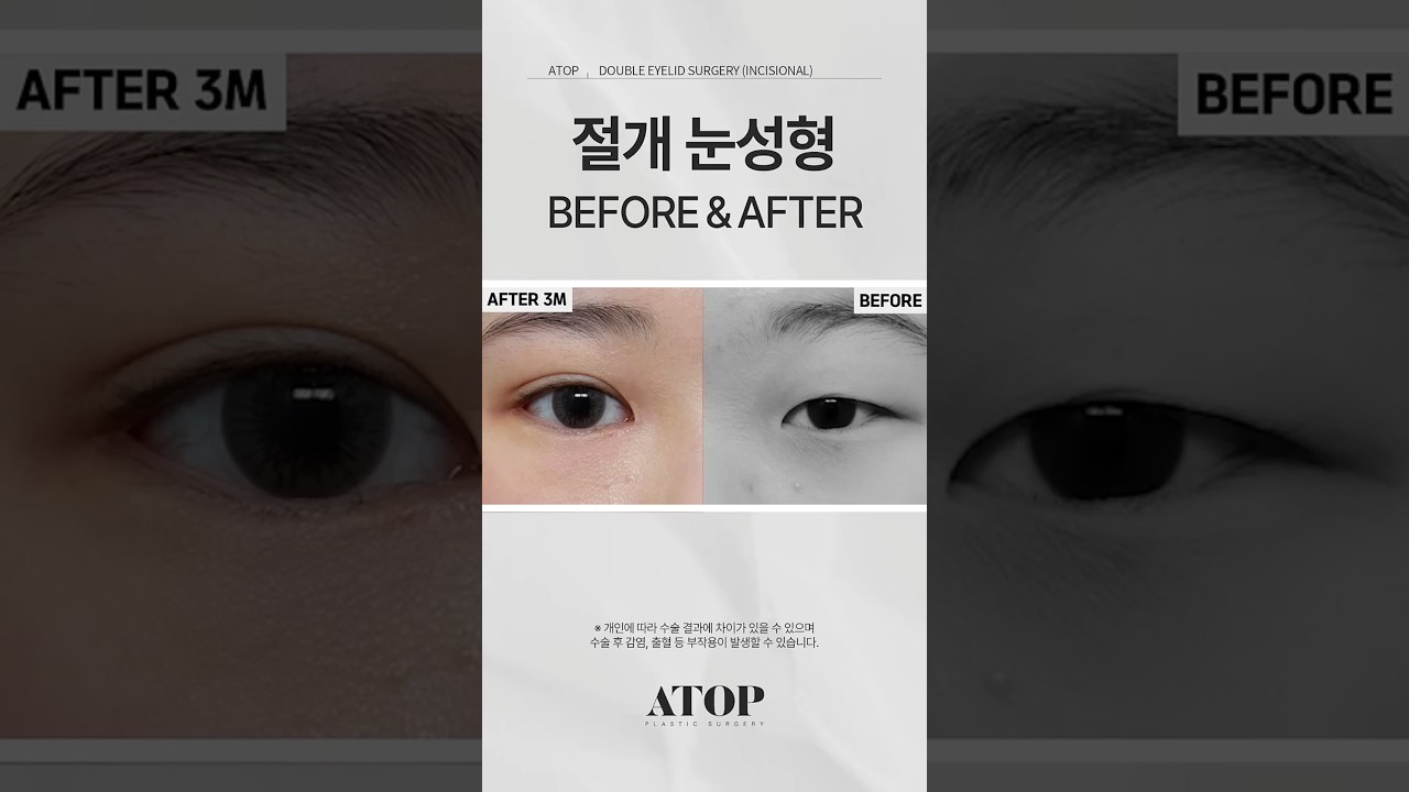 [A-TOP Phẫu thuật thẩm mỹ] Nâng mắt cắt mí nữ_Review 4