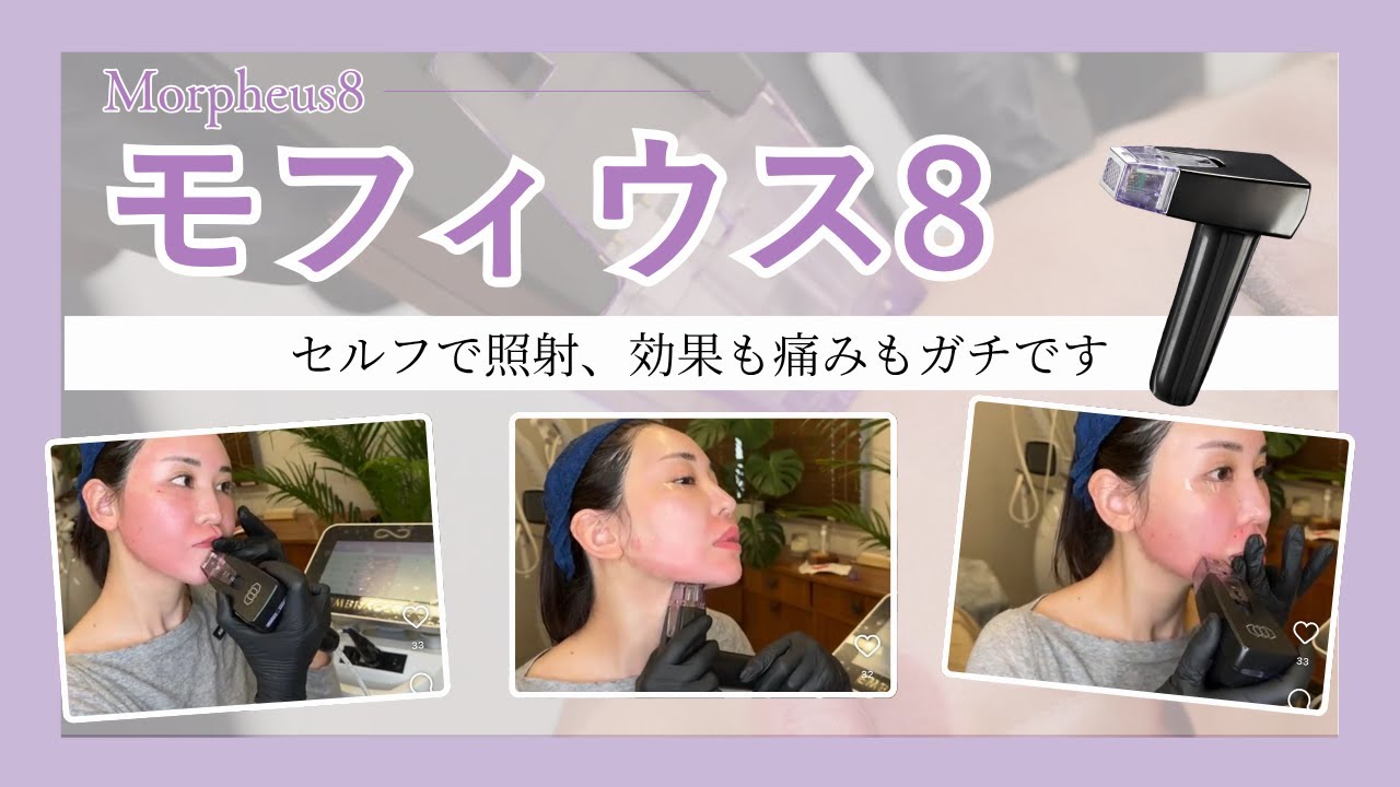 【モフィウス8】たるみに本気すぎる美容ナースがセルフで打ってみた｜痛み・効果・当て方を全部正直にレビュー