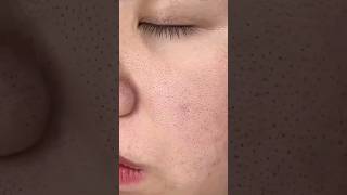 viral Easy blackhead removal at home  | Home remedy? skincare blackheads shorts