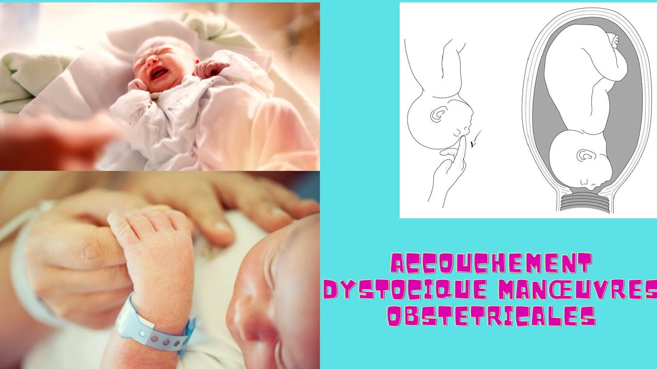 ACCOUCHEMENT DYSTOCIQUE MANŒUVRES OBSTETRICALES  2023-22-01
