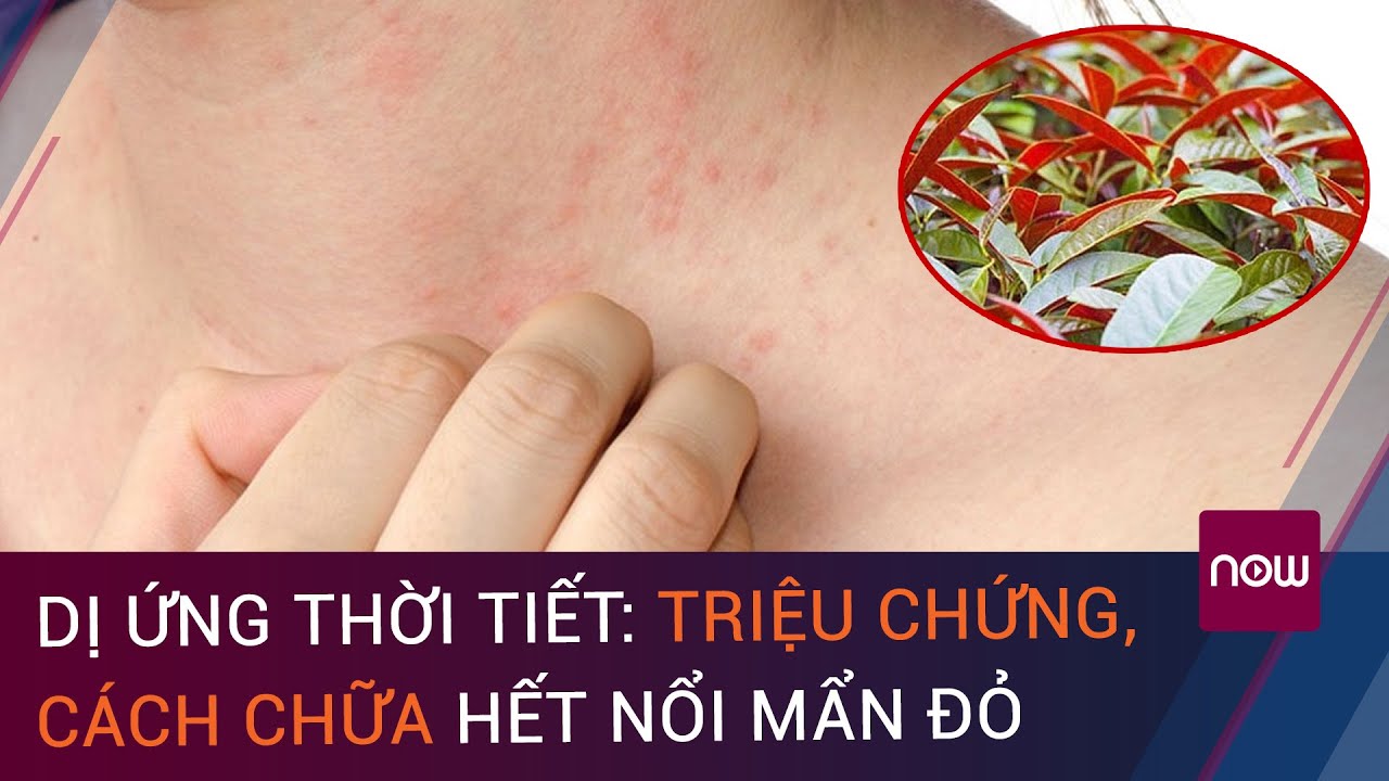 Dị ứng thời tiết: Triệu chứng, cách chữa hết nổi mẩn đỏ | VTC Now