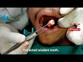 Surgical extraction of wisdom tooth bright line dental care dr swostik devkota nepali dentist