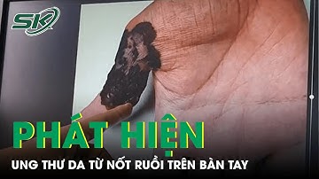Nam Thanh Niên Hà Nội Phát Hiện Ung Thư Da Từ Nốt Ruồi Trên Bàn Tay | SKĐS