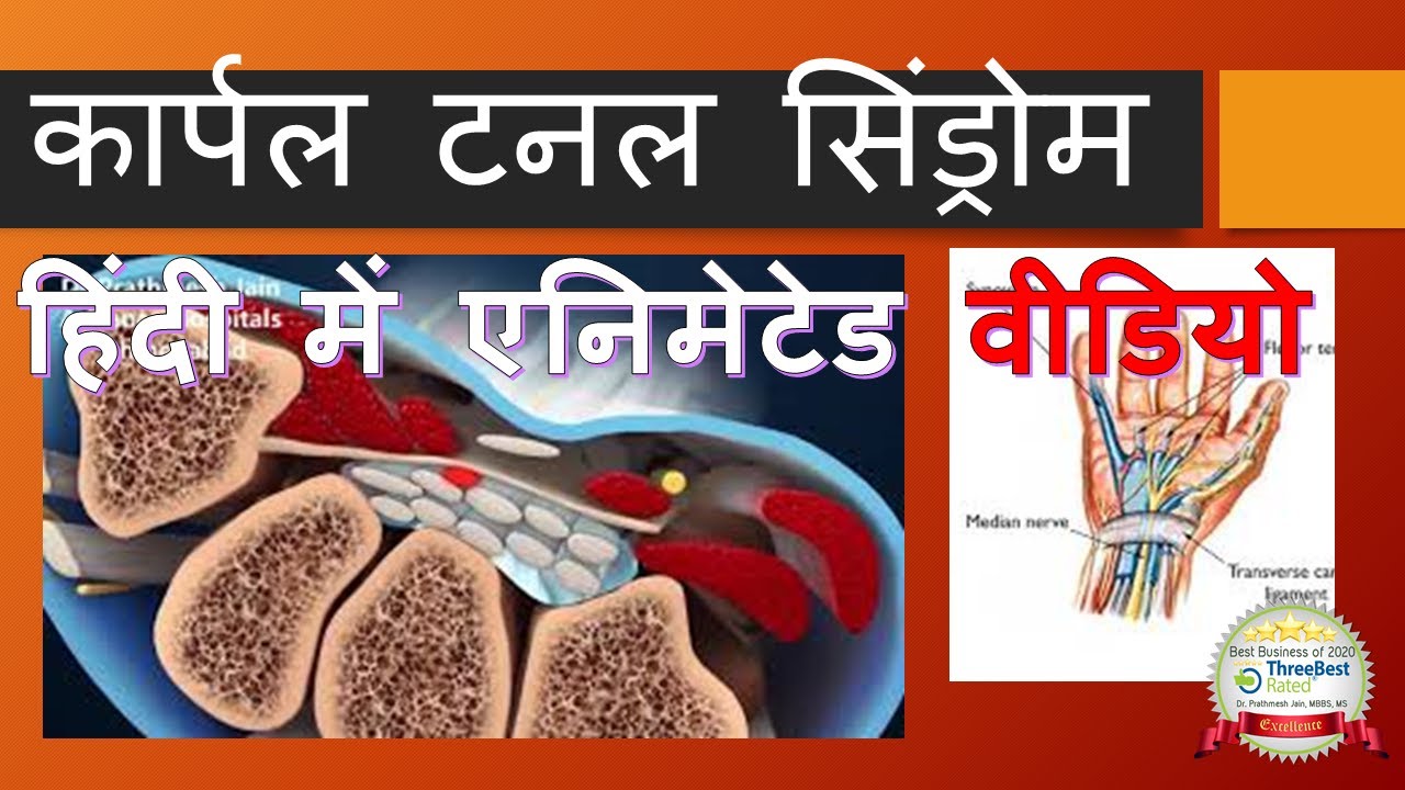 Carpal Tunnel Animated Hindi कार्पल टनल सिंड्रोम हिंदी में एनिमेटेड ...