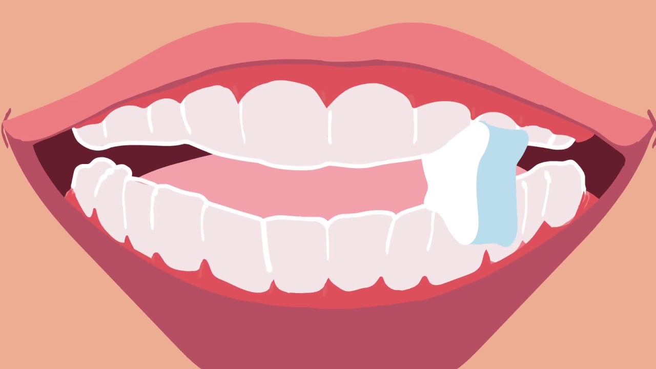 Movemints Mints Movemints, the Mint that Fits™ Your Clear Aligners! - YouTube