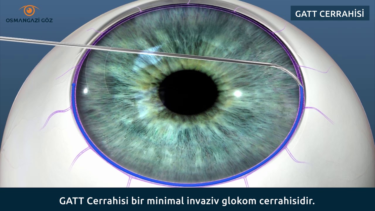Hipertansiyona dikkat: Kalıcı görme kaybına yol açabilir | Medipol Sağlık Grubu