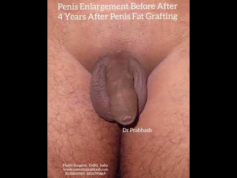 Female Sexual Dysfunction