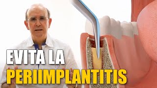 ¿Qué es la periimplantitis? Cómo evitarla o tratarla sin pérdida de hueso