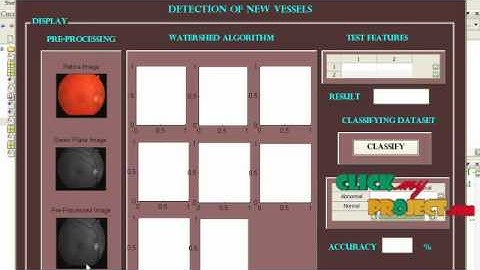 Final Year Projects |Detection of New Vessels on the Optic Disc Using Retinal Photographs