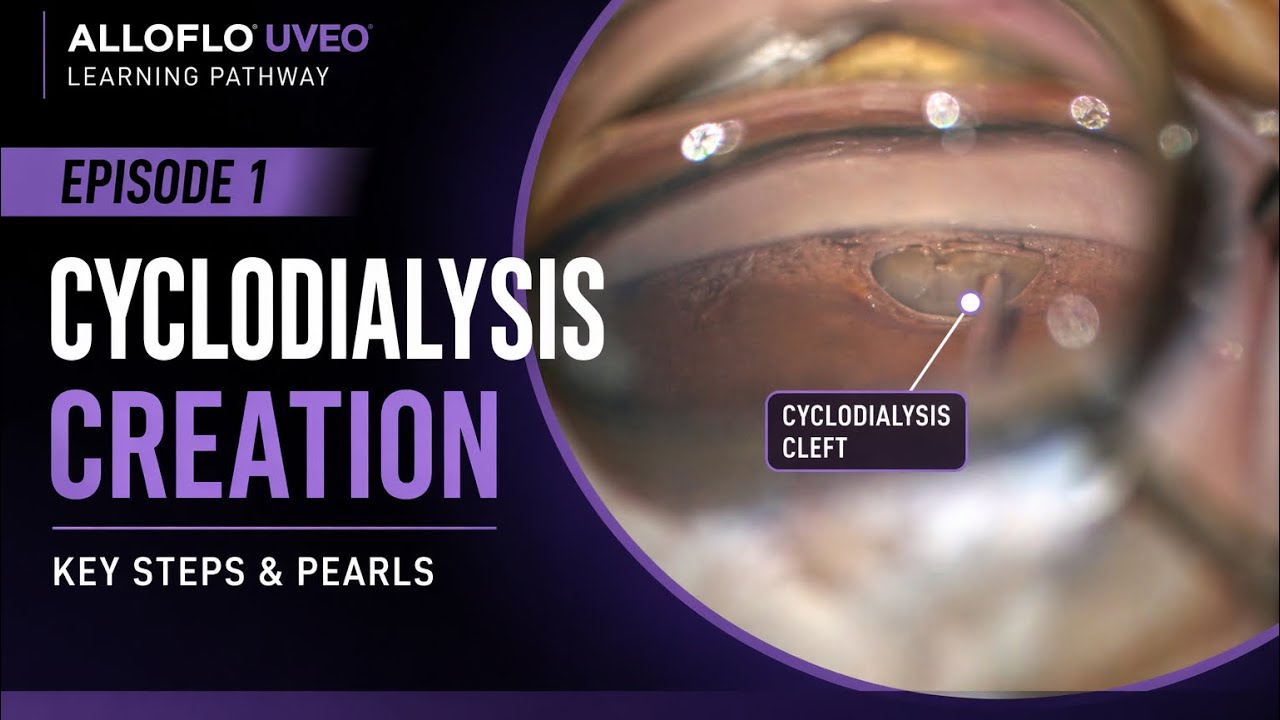 AlloFlo Uveo Cyclodialysis Creation | Key Steps & Pearls - YouTube