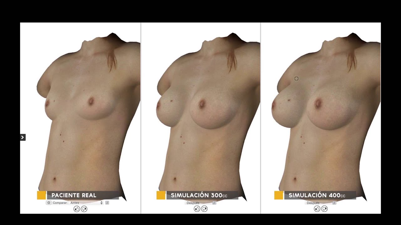Aumento de senos natural antes y despues de adelgazar