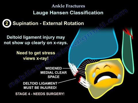 Ankle Fractures - Everything You Need To Know - Dr. Nabil Ebraheim