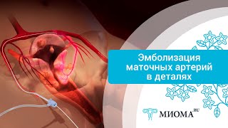 Лечение миомы матки методом ЭМА