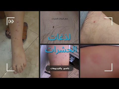 شكل قرصات الحشرات بق الفراش والبراغيث والفاش والناموس والقراد وقمل الرأس