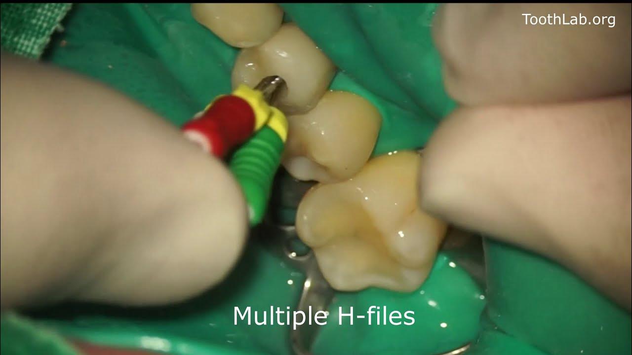 Root canal retreatmentGutta percha removal YouTube