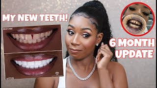 DO I REGRET GETTING VENEERS IN TURKEY?! *THE TRUTH* | 6 Month Update Q&A