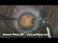 Basic cataract surgery in Real Time narrated by Shannon Wong, MD.  7-13-14