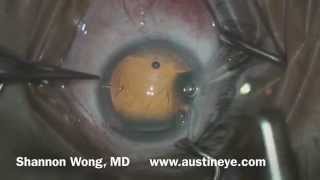 Basic cataract surgery in Real Time narrated by Shannon Wong, MD.  7-13-14