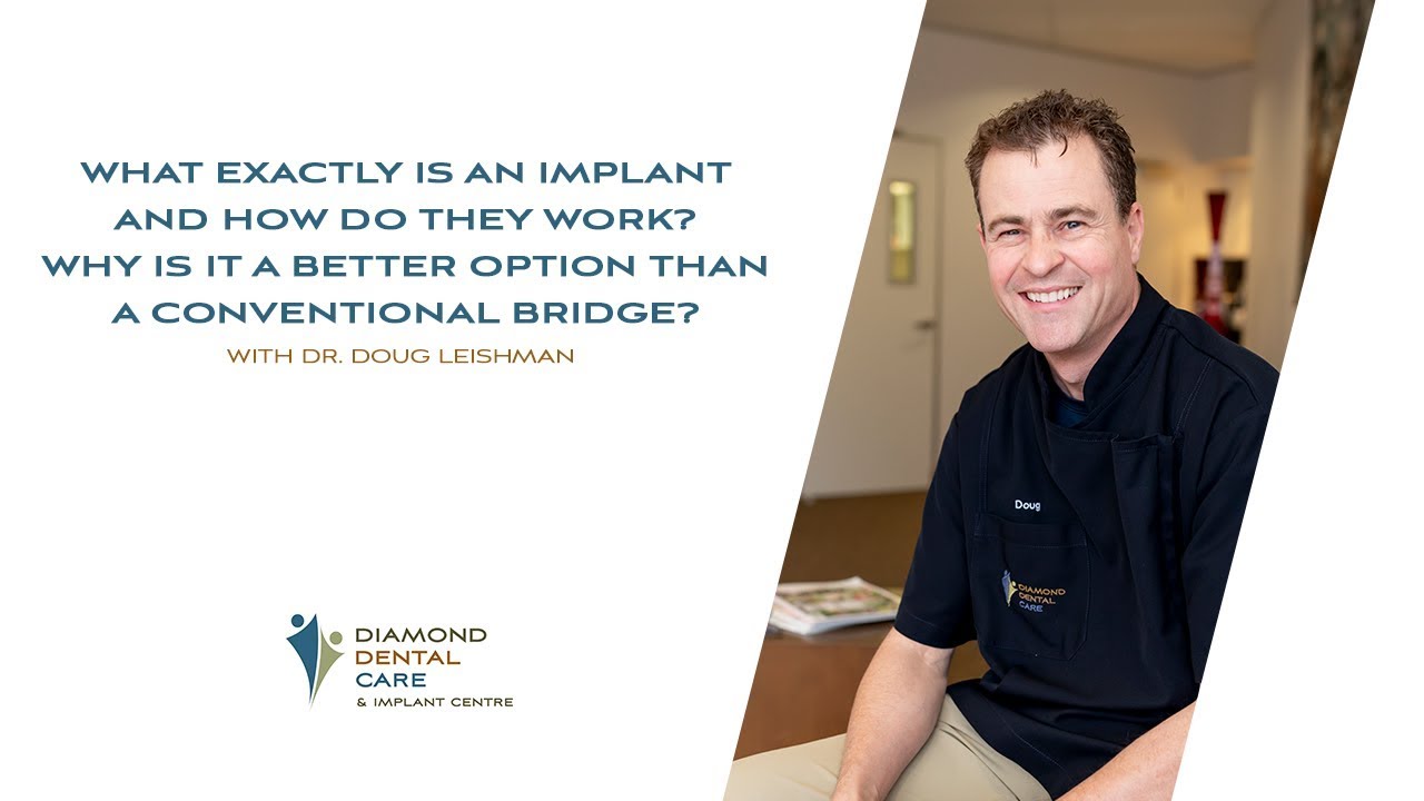 What exactly is an implant and how do they work? Diamond Dental Care