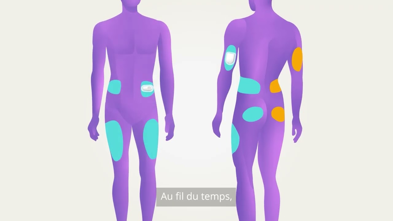 Connexion du capteur Omnipod® 5 avec Dexcom G6