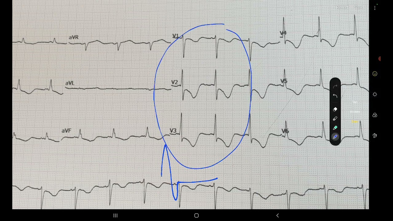ECG week 20: STEMI OR NSTEMI?