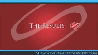 Rhinoplasty (Nose Surgery) in San Diego, La Jolla, California