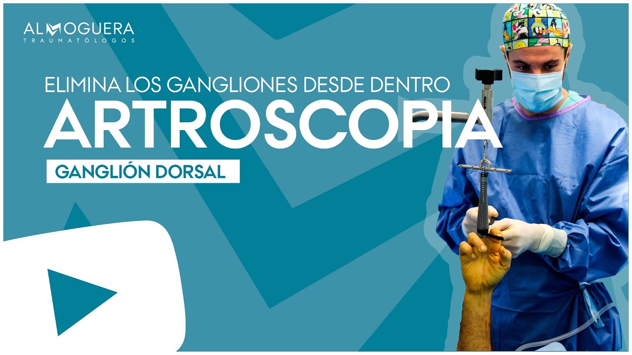 Tratamiento de Ganglión Dorsal en la Muñeca por Artroscopia - YouTube