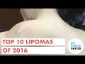 2016 Top 10 Lipomas Revisited