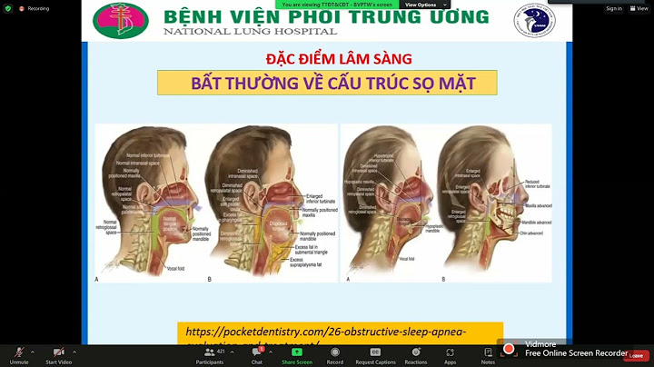 Làm thế nào để chữa ngáy khi ngủ năm 2024