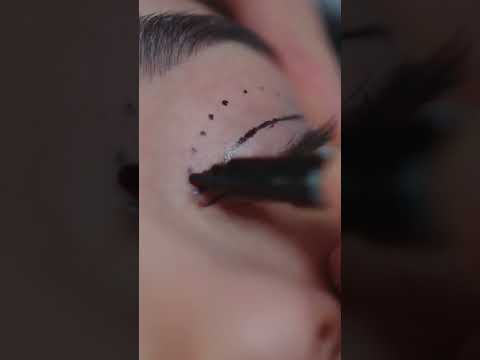 ما هي عملية رأب جفن العين