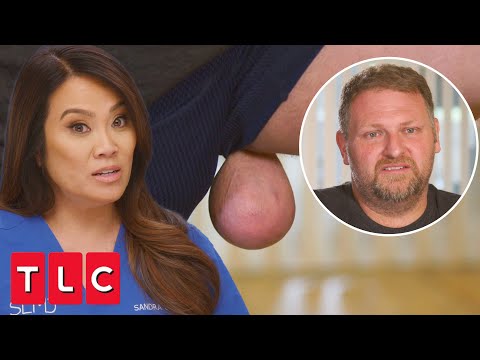 Pastor Has a Hanging Growth in an Embarrassing Location | Dr. Pimple Popper (Extended)