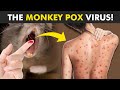 From Mouse Bites to M Pox: A Complete Guide to Monkey Pox Virus