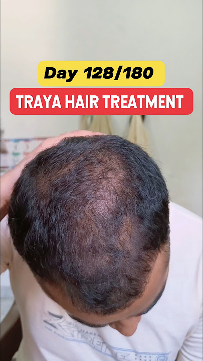 Download lagu Day 128/180 Traya Hair Regrowth Journey