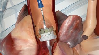 What to Expect: Transcatheter Aortic Valve Replacement (TAVR)