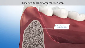 Welches Medikament fördert den Knochenaufbau?