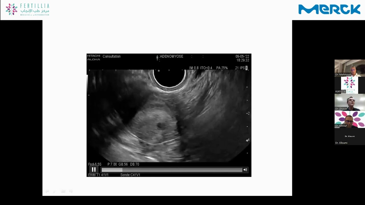 Webinaire#14 FERTILLIA : L'énigme de l'adénomyose en FIV : Quelle solution ?