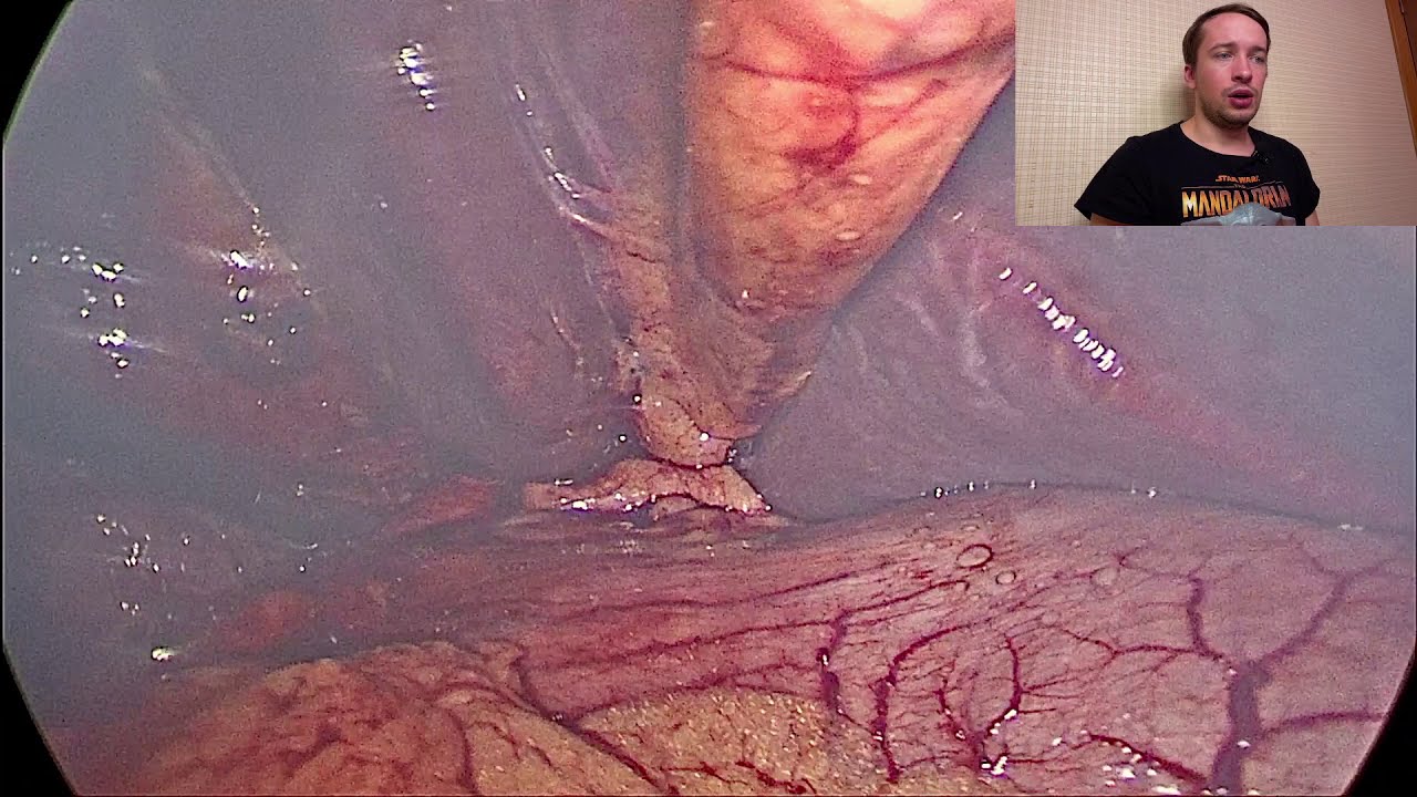 Удаление желчного пузыря. Перивезикальный абсцесс? Эмпиема пузыря? Гангрена? Стоит ли он того?