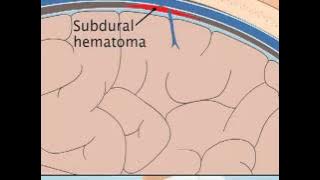 Understanding Subdural Hematoma