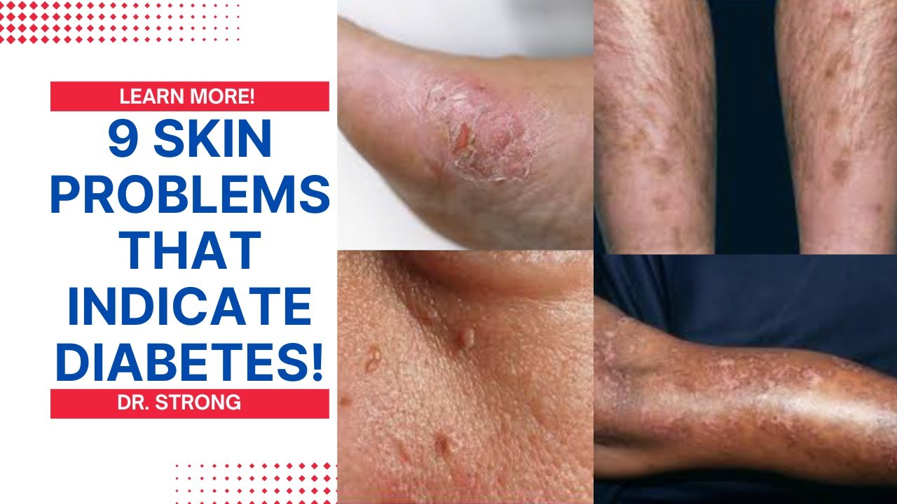 9 Diabetic Skin Problems You Shouldnt Ignore Signs Of Diabetes You